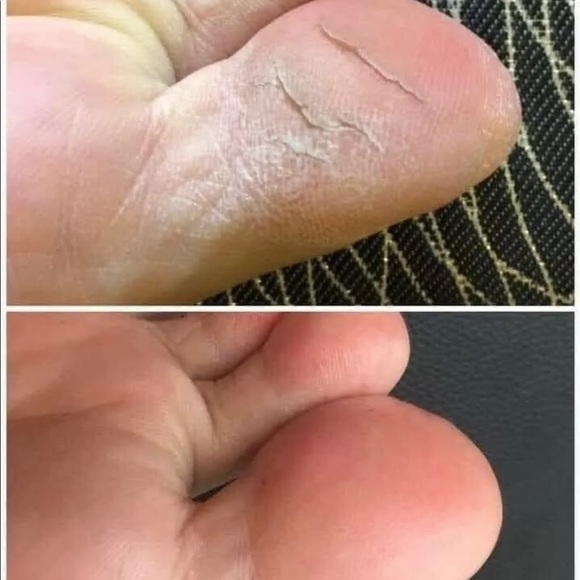 (1) Epoch Foot Treatment Sole solution - Picture 6 of 8